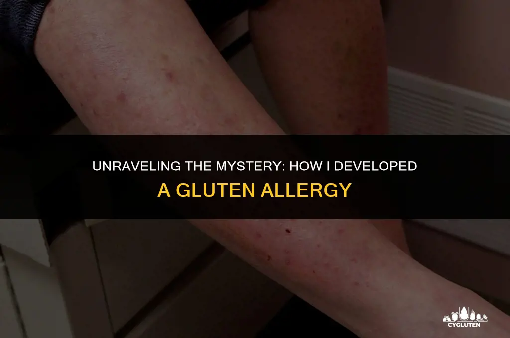 how did i develop a gluten allergy
