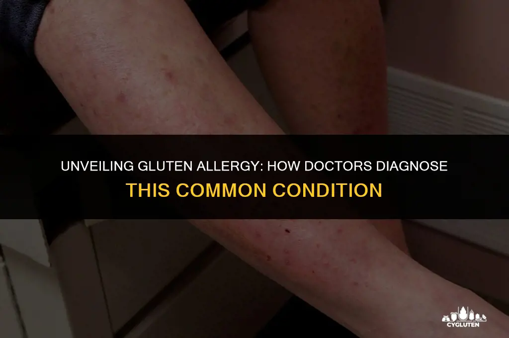 how do dr tell thta you are allergic to gluten