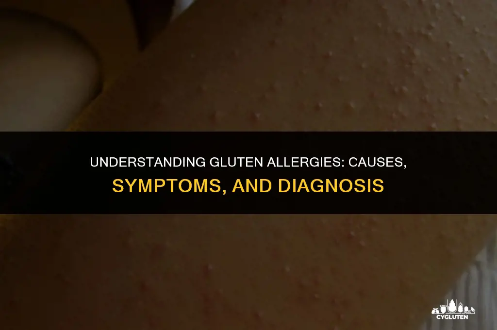 how do you get a gluten allergy