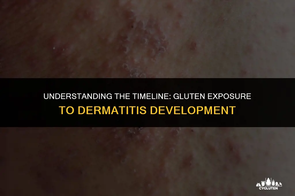 how long between exposure to gluten and development of dermatitis