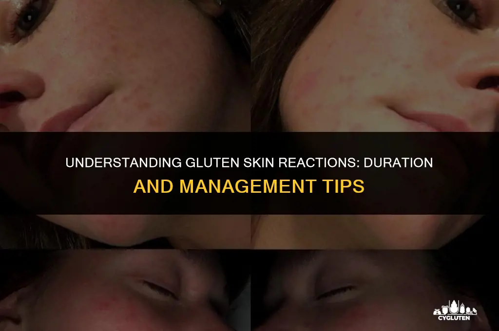 how long does a gluten skin reaction last