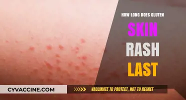 Understanding Gluten Skin Rash: Duration and Management Tips
