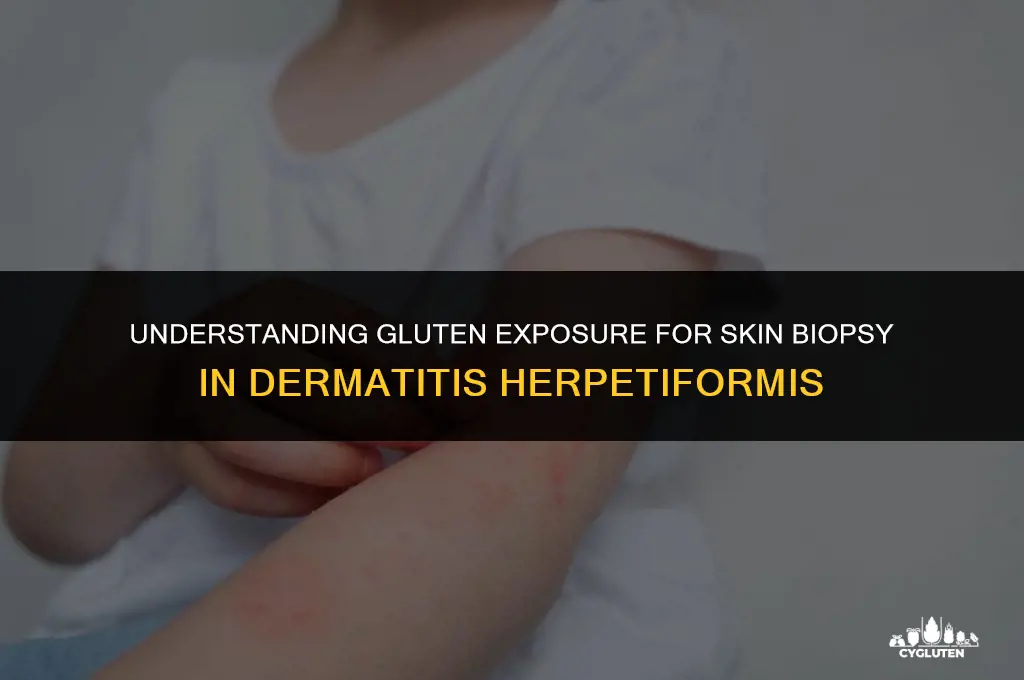 how long on gluten for skin biopsy dermatitis herpetiformis