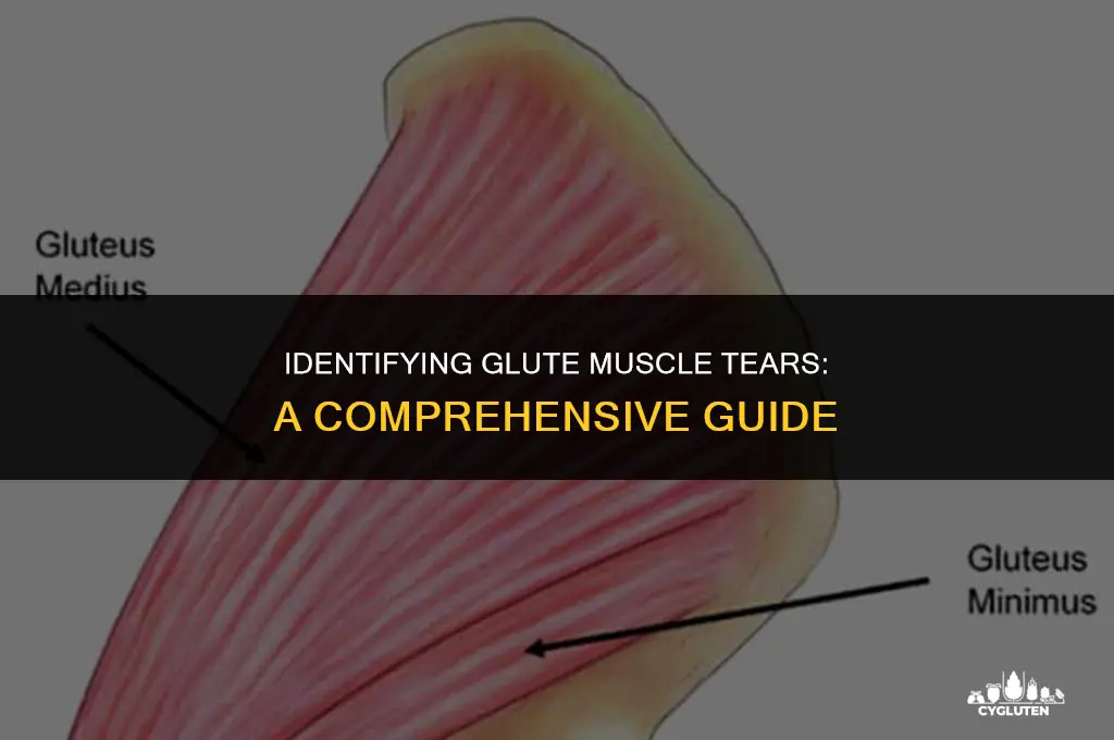 how to diagnose a muscle tear in the glute