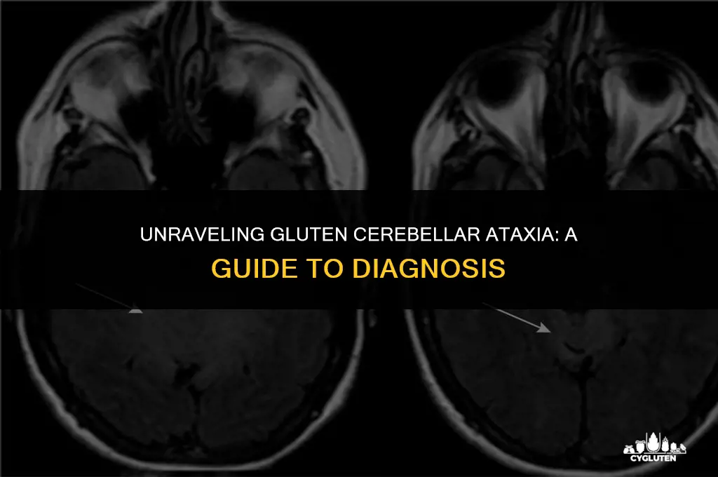 how to establish if you have gluten cerebellar ataxia
